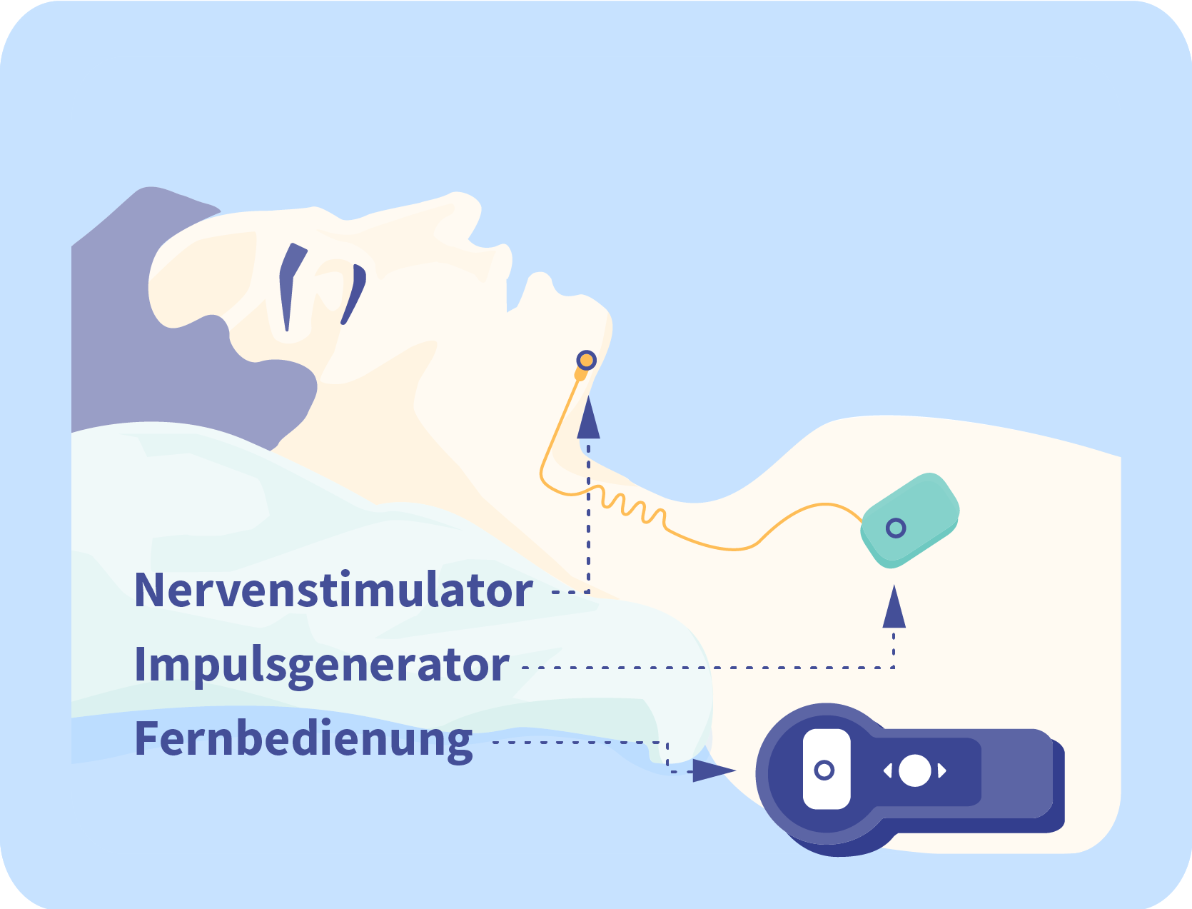Welche Alternativen zur Schlafapnoe Maske gibt es?