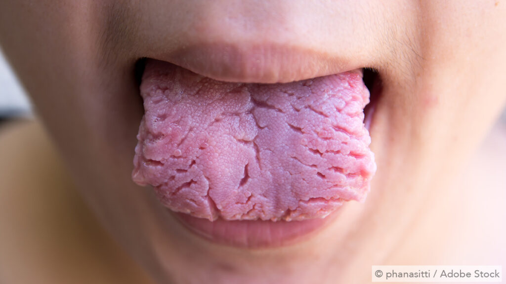 46+ Risse in der zunge bilder , Die medizinischen Folgen eines trockenen Mundes